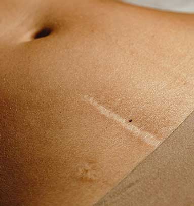 Abdomen PostParto