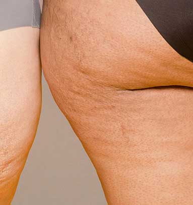 Celulitis