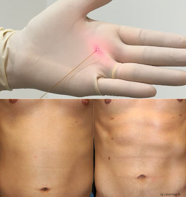 Endolift