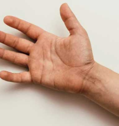 Hiperhidrosis
