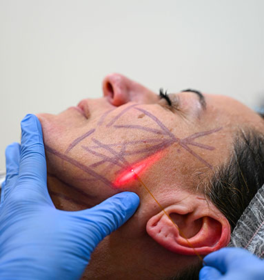 Endolift Facial