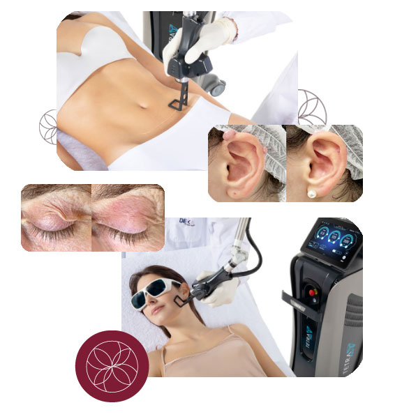 Blefaroplastia Láser