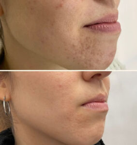 Dermatología Tratamiento de Acné