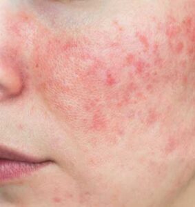 Rosácea