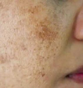 Melasma