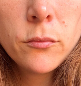 Armonización Facial